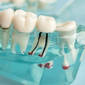 painless root canal process near me