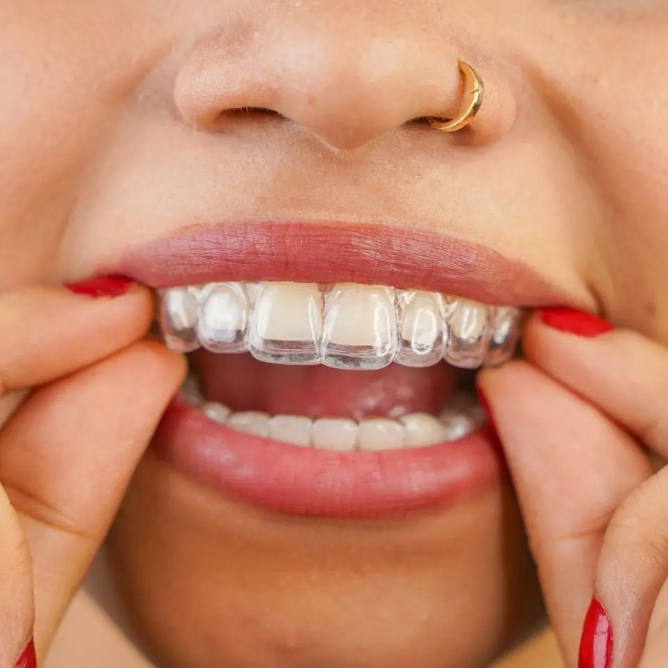 safe aligners treatment in tirupati