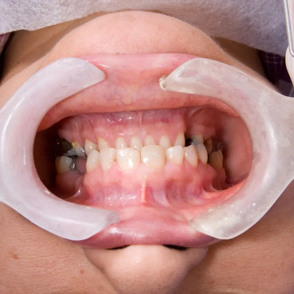full mouth rehabilitation