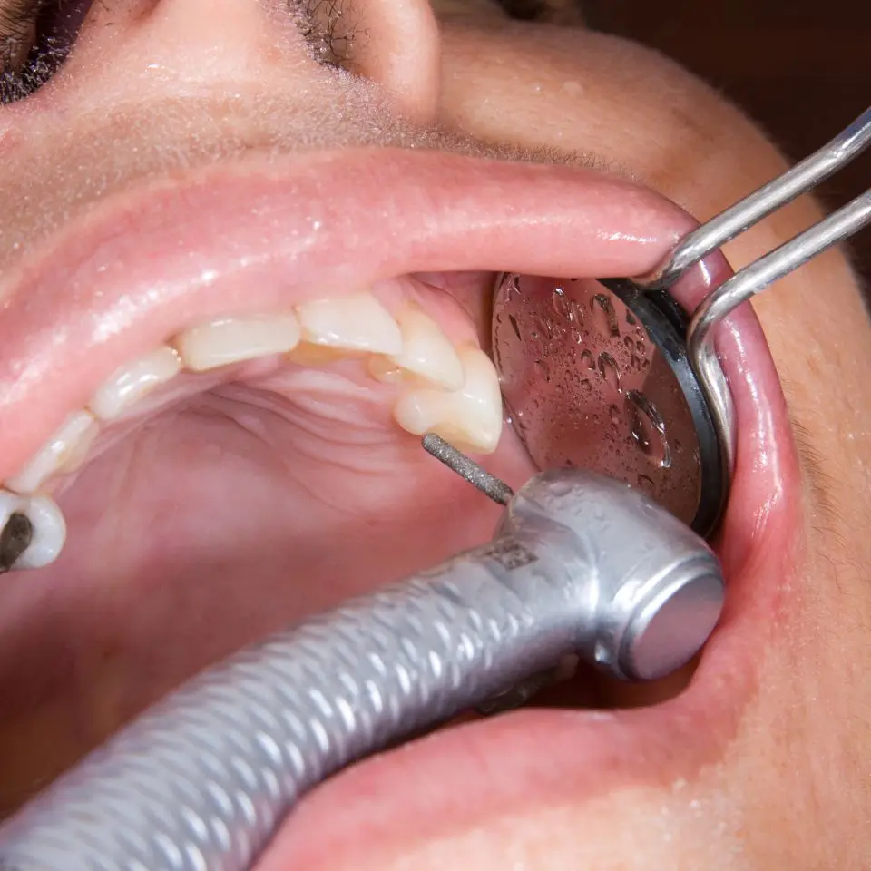 dental rehabilitation
