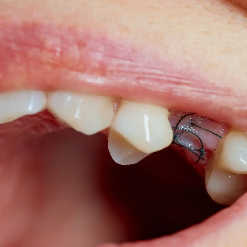 best dental implant services for healthy teeth
