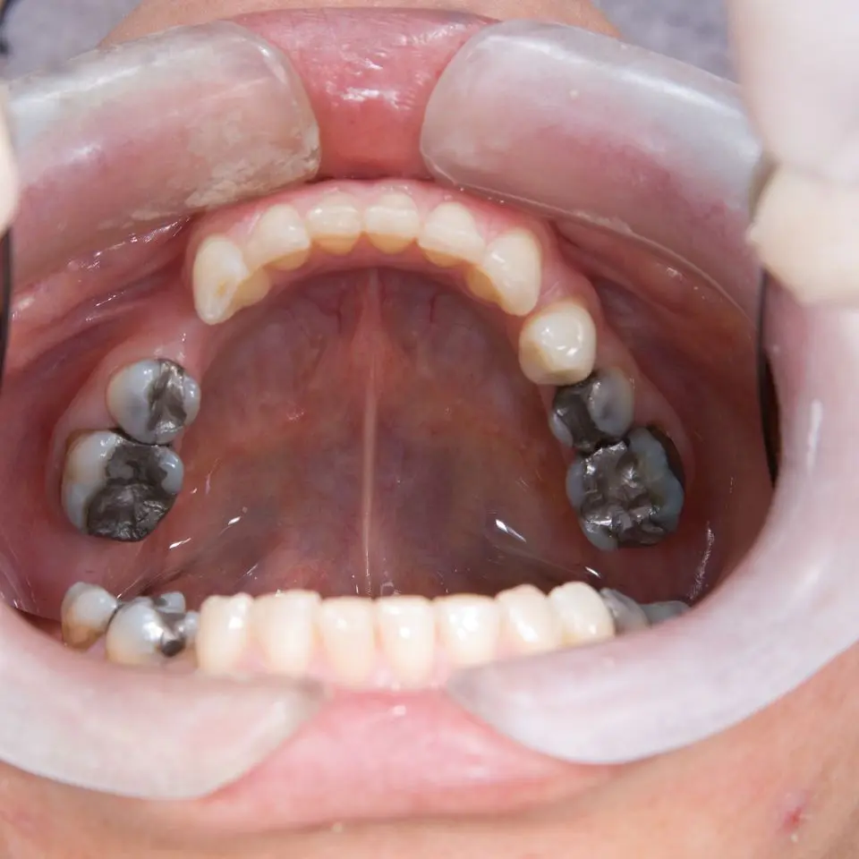 tooth recovery