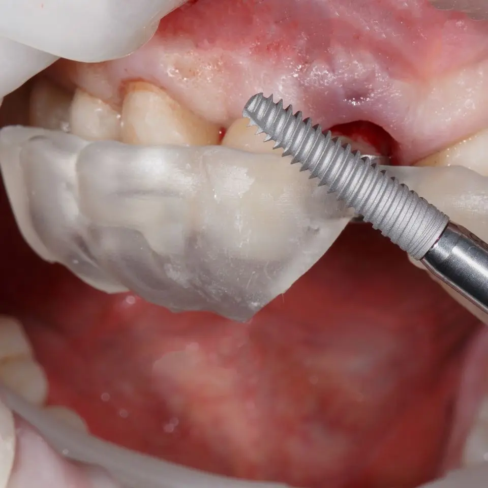 dental cover treatments in tirupati