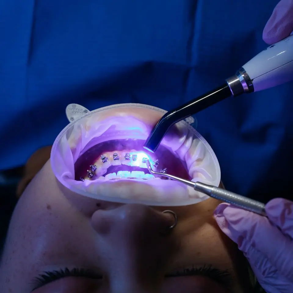 laser teeth whitening services in tirupati