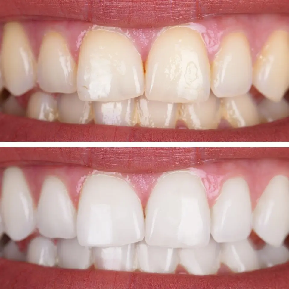 teeth whitening services in tirupati