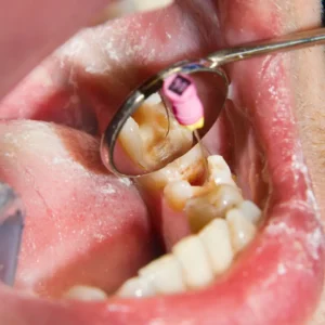 Root canal