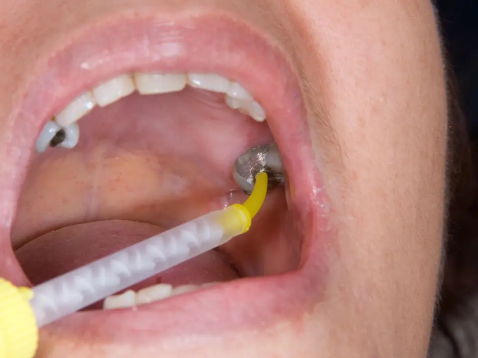 full mouth dental treatment services in tirupati