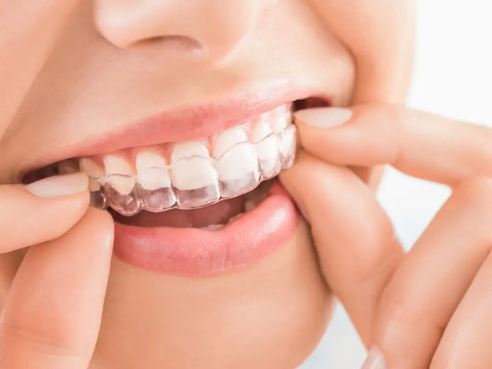 invisalign treatment in tirupati