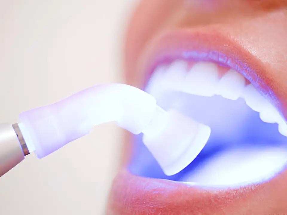 laser teeth whitening in tirupati