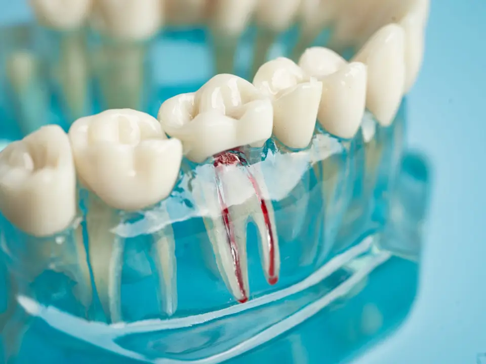 root canal