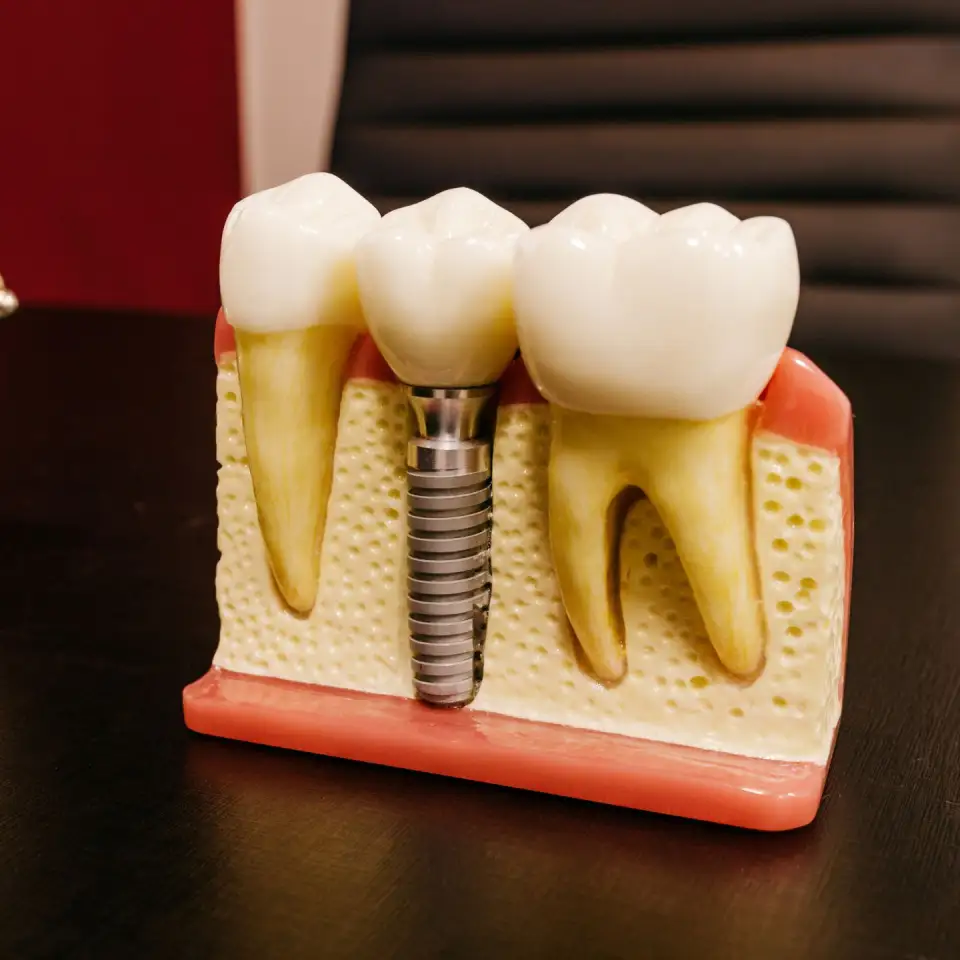 dental implants in tirupati
