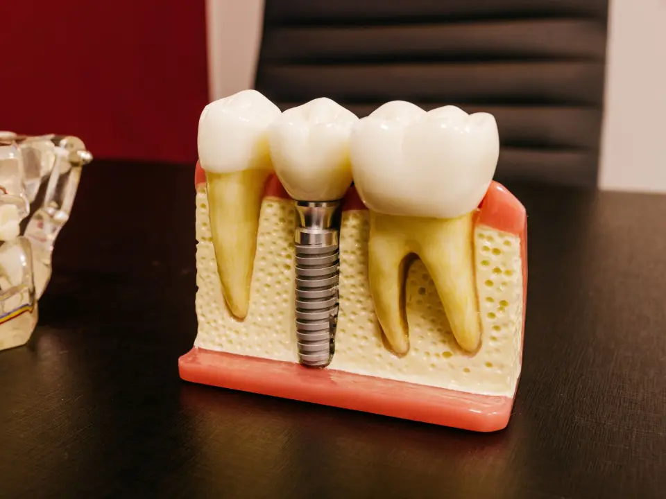 dental implants in tirupati near me